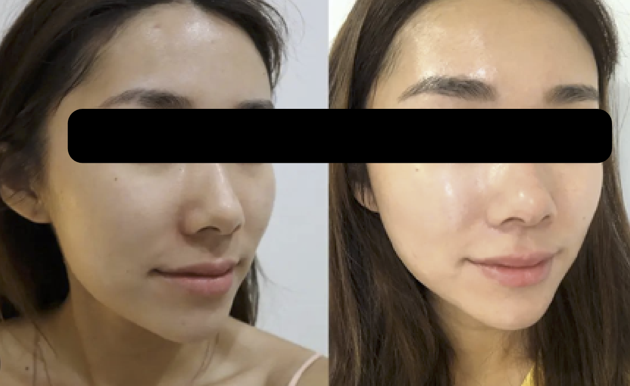 PDRN - Skinlife Clinics